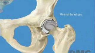Birmingham Hip Resurfacing Procedure