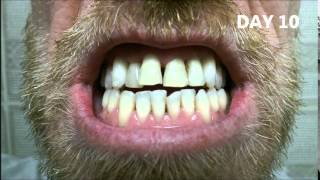CREST 3D Whitestrips LUXE SUPREME Flexfit A smoker's Journey