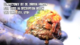 Treatment & Therapy (REDUX) Removal & Growths