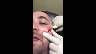 Вот почему не следует давить прыщи / That's why you should not squeeze pimples (18+)