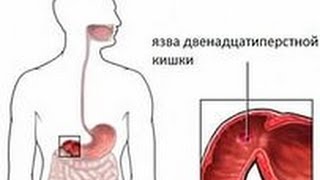 Язва 12 Перстной Профилактика и Лечение