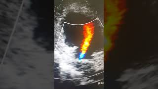 Case # 34 echocardiography Fenestrated extra cardic Fontan operation