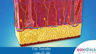 Lipofilling (injection de graisse)