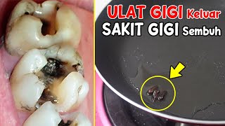 BUKAN RESEP GIGI BIASA! SAKIT GIGI MEMBANDEL SEMBUH TOTAL DENGAN RESEP INI 