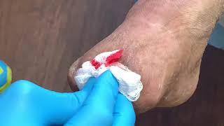 CASE UPDATE: DEBRIDEMENT OF THE TRANS-METATARSAL DEFECT ❤️?❤️?❤️