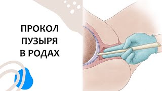 ЗАЧЕМ прокалывают ОКОЛОПЛОДНЫЙ ПУЗЫРЬ. Роды без страха. Выпуск 76