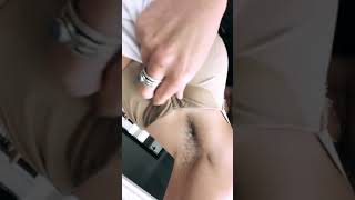Hyperhydrosis hairy sweaty armpits