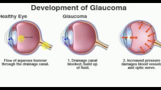 OPTHALMOLOGY GLAUCOMA  PART 1 BASICS Drainage of aqueous humour