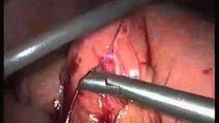 Laparoscopic Biliary By-pass