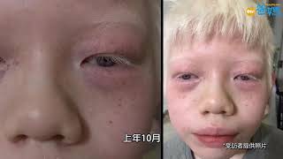 【專訪】四個孩子，三個白化病
