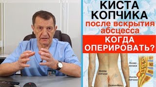 Киста копчика - когда нужно оперировать кисту копчика после вскрытия его абсцесса?
