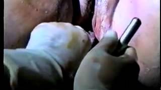 Vacuum extraction (Metal)