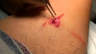 Berto gets stabbed!!!