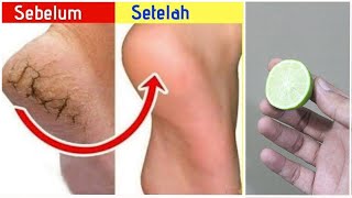 CARA TRAMPUH MENGATASI KAKI PECAH-PECAH SECARA ALAMI - MENGATASI KAKI PECAH PECAH DENGAN JERUK NIPIS