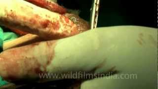 All gain, no pain - Breast fibroadenoma surgery!