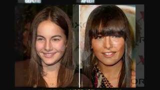 Celebrity Plastic Surgery (before and after)