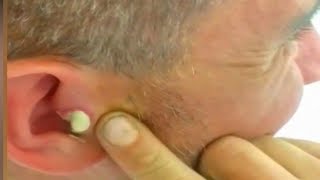 Squeezing Roufas' Big Ear Pimple!  Medical Case Study ????