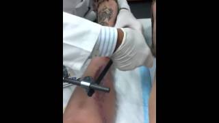 Gory Post-Op: Removing the External Fixator