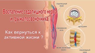 Воспаление седалищного нерва и грыжа позвоночника   Как вернуться к активной жизни?