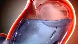 Weight loss pill inflates in stomach to make person feel full