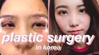 DOUBLE EYELID SURGERY RECOVERY VLOG | Seoul, Korea