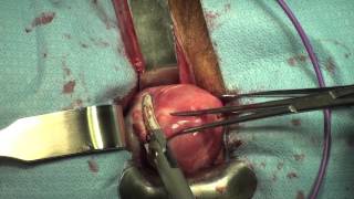Total Vaginal Hysterectomy