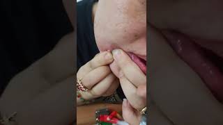 Pha nặn mụn lịch sử  của  anh mập