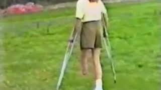 Tamra, Sbk with and without Prosthetic