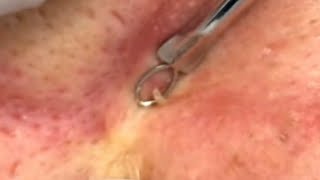 blackheads