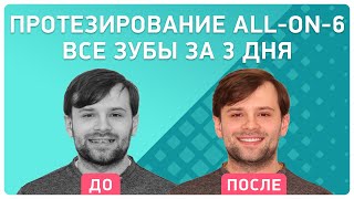 Имплантация all-on-6® всего за 3 дня ? отзыв пациента клиники Smile-at-Once