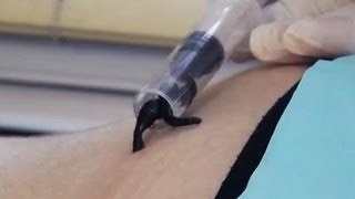 Гирудотерапия в Гинекологии. Мужское и Женское Бесплодие. Пиявки. Говорит ЭКСПЕРТ /Says Expert/