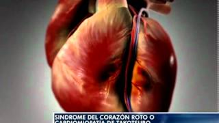Sindrome del Corazón roto o Cardiomiopatía de takotsubo