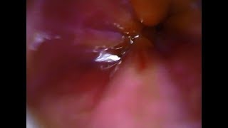 Inside my Stomach and Esophagus Vore