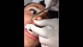 Girl Has a Giant Worm Her Lips