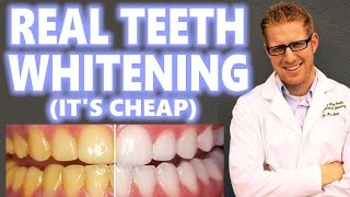 Teeth Whitening at Home Cheap How to Peroxide Hacks DIY Bleach Trays Kit Best 2016 Overnight Results