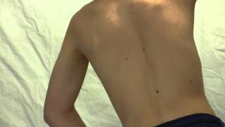 schroth exercises for scoliosis