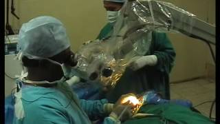 Stapes surgery UNEDITED ( Case 3 ) - Dr .Vijayendra