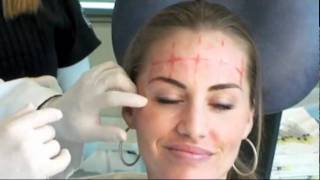 BOTOX BEFORE AFTER Beautiful South Beach Model Dermatology