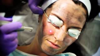 Lutronic - Spectra Peel