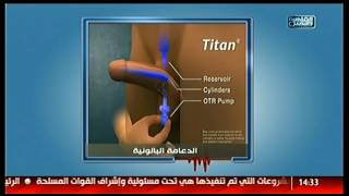 Les avantages de l'implant pénien