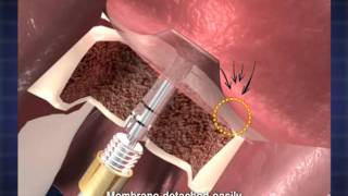 IBS implant #Over 3mm thickness of sinus floor