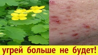 КАК ВЫЛЕЧИТЬ УГРИ И БОРОДАВКИ ЧИСТОТЕЛОМ/ THE HANDS AND THE SHARROWER WILL NOT BE MORE!