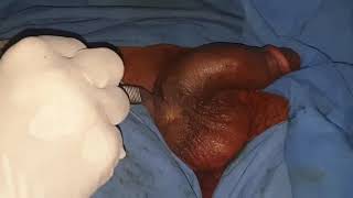 TESTICLE IMPLANT SURGERY