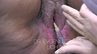 Лечение крауроза (лихена вульвы) - Lichen Sclerosis treatment