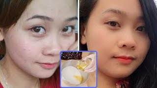 Tuyệt chiêu giảm mụn giúp da trắng sáng hết thâm của cô nàng 9X