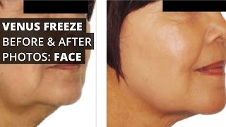 Venus Freeze™ Before & After Photos: Face