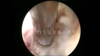 Tam Endoskopik Bel Fıtığı Cerrahisi (Full-endoscopic discectomy)