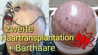 ZWEITE Haartransplantation Türkei vorher nachher/Barthaare auf Kopf transplantiert /Verdichtung?