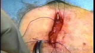 Temporal Artery Biopsy for Giant Cell Arteritis
