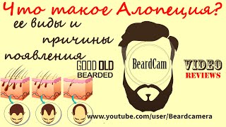 Что такое Алопеция? ее виды и причины появления